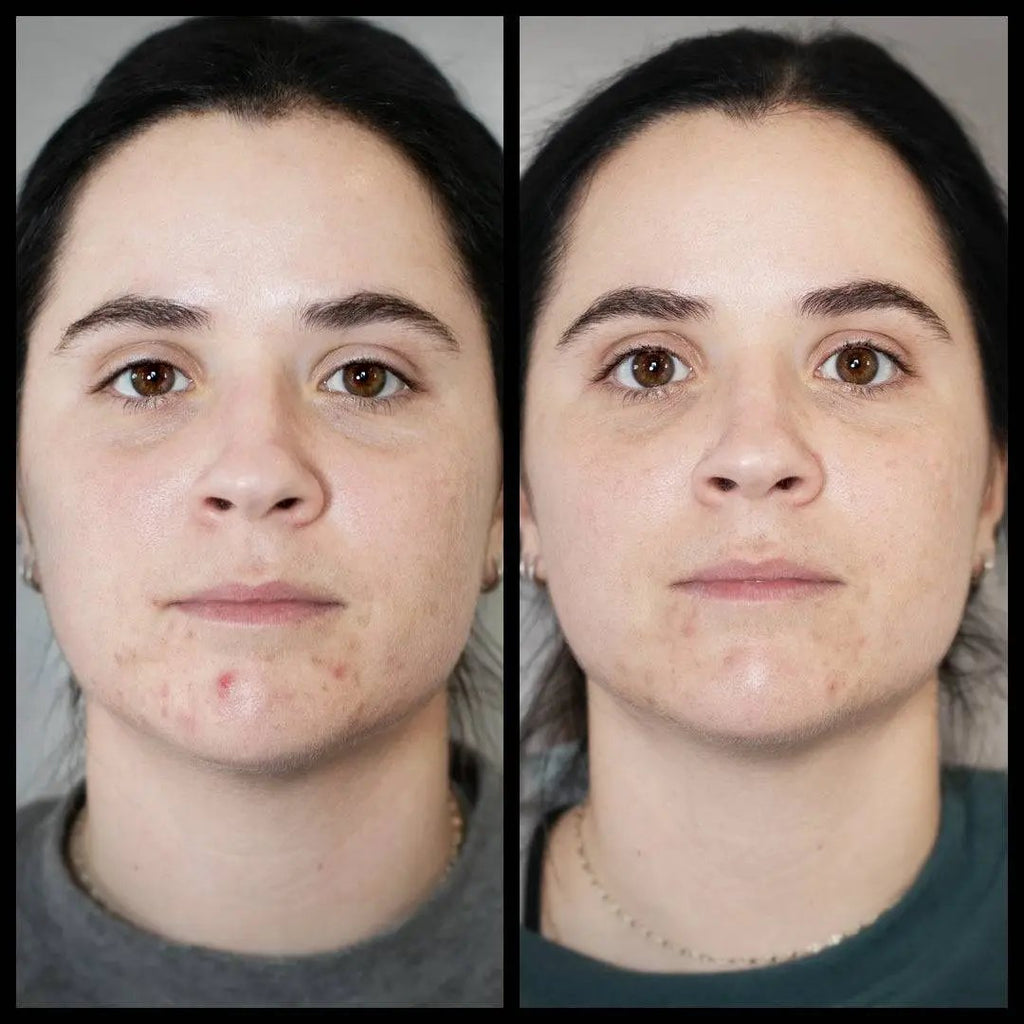 Before and after comparison of a person with acne on their face.
