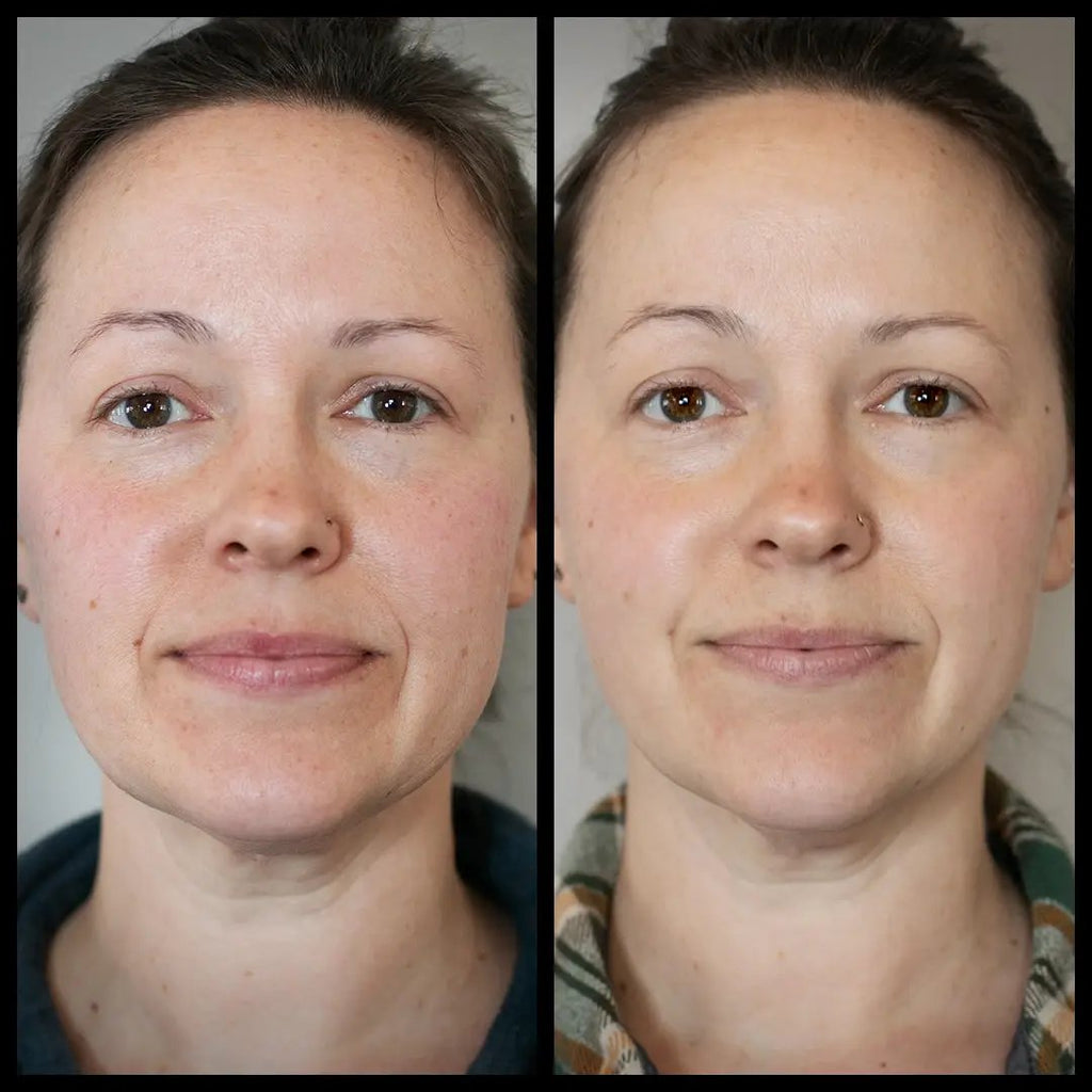 Before and after comparison of a woman with visibly less redness in face