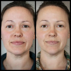 Before and after comparison of a woman with visibly less redness in face